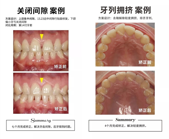 美加隱形矯正案例