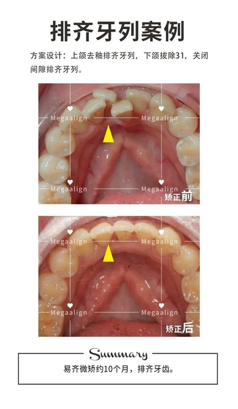 關(guān)于牙齒出軌這事兒吧……