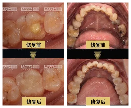 使用美加嵌體修復(fù)前后對比