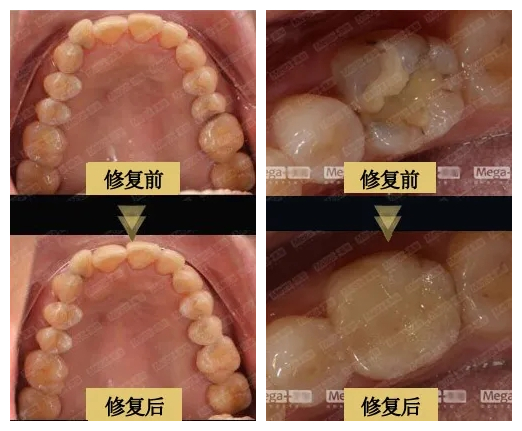 使用美加嵌體修復(fù)前后對比