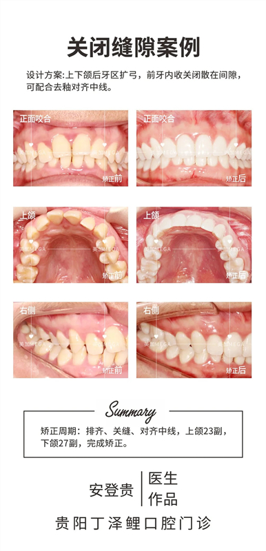 關(guān)閉牙齒縫隙案例