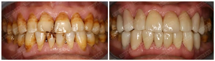 修復(fù)前后對(duì)比—口內(nèi)照