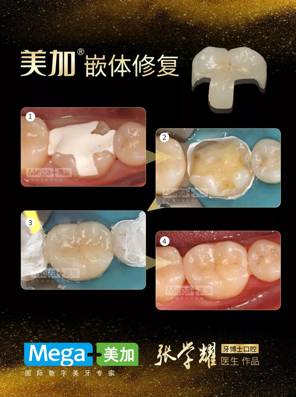 使用美加嵌體修復(fù)案例