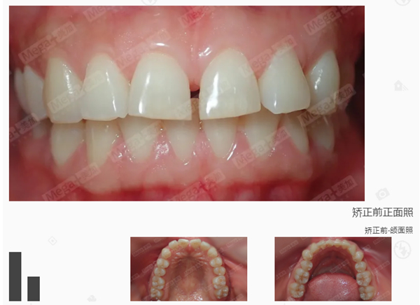 矯正前口內(nèi)照