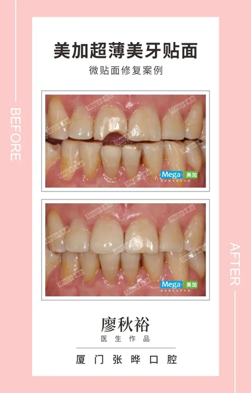 美加貼面修復(fù)牙缺損案例