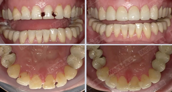 美加超薄美牙貼面修復案例